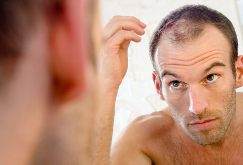 Kouty a řidké vlasy prři vypadávání vlasů u mužů