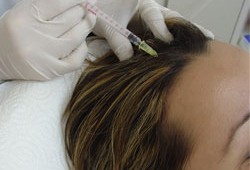 Vlasová mezoterapie vám dokáže vrátit bujnou hřívu