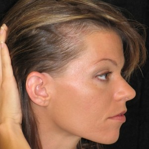Typy plešatění: Alopecia areata aneb když váš vlastní imunitní systém napadá vlasy