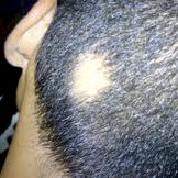 Alopecie - problém, který se nás týká